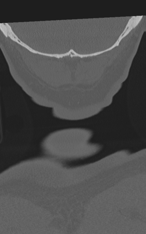 Cervical spine fractures with vertebral artery dissection (Radiopaedia 53296-59268 Coronal bone window 77).png
