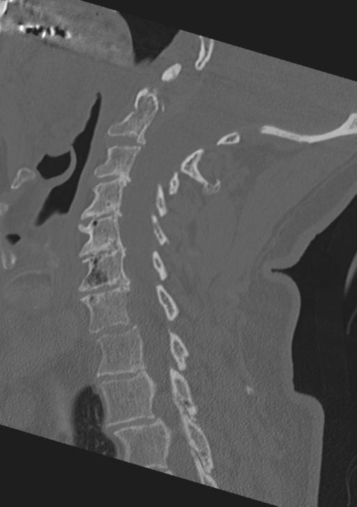 Cervical spine fractures with vertebral artery dissection (Radiopaedia 53296-59268 Sagittal bone window 39).png