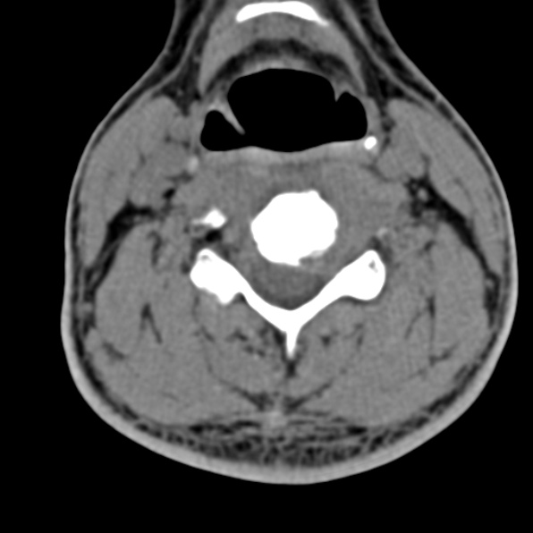 Cervical spondylodiscitis (Radiopaedia 28057-29489 Axial non-contrast 42).jpg