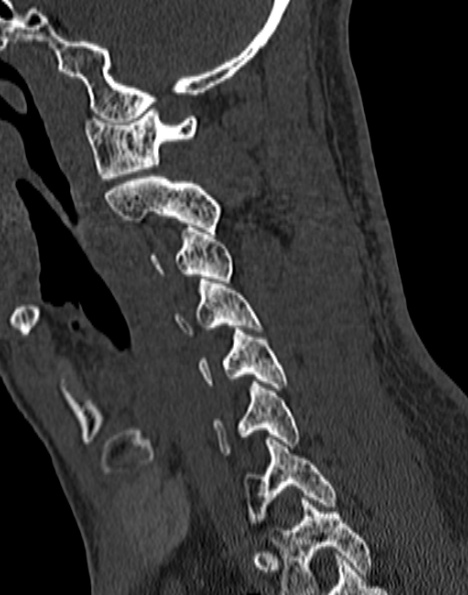 File:Cervical spondylodiscitis (Radiopaedia 28057-29489 Sagittal bone window 26).jpg