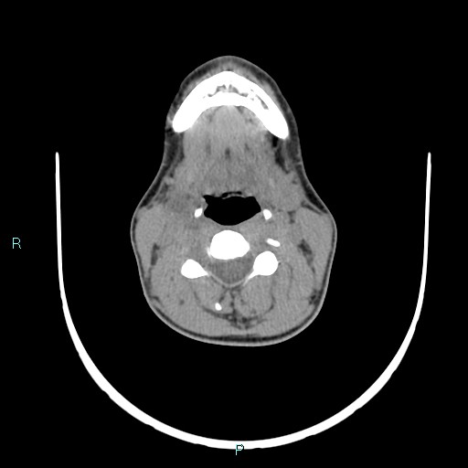 File:Cervical thymic cyst (Radiopaedia 88632-105335 Axial non-contrast 67).jpg