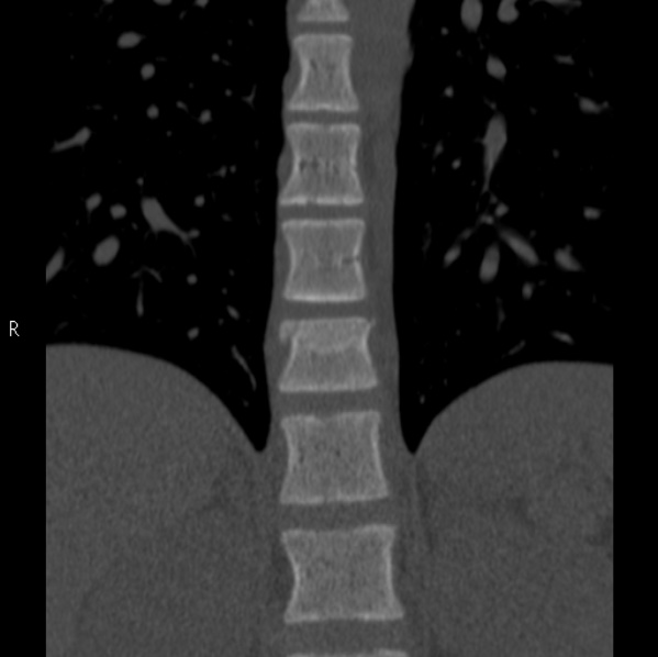 Chance fracture (Radiopaedia 36521-38081 Coronal bone window 9).jpg