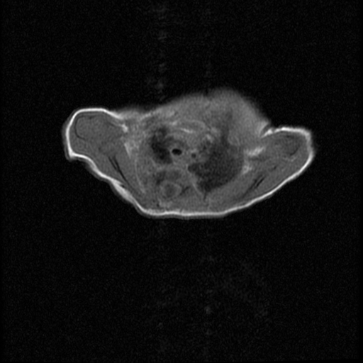 File:Chiari II malformation with spinal meningomyelocele (Radiopaedia 23550-23652 Axial T1 2).jpg
