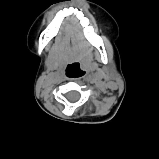 Chiari I with syrinx and skull base anomalies (Radiopaedia 89444-106412 Axial non-contrast 70).jpg