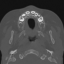 Choanal atresia (Radiopaedia 88525-105975 Axial bone window 1).jpg