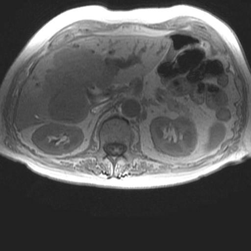 File:Cholangiocarcinoma - mass-forming pattern (Radiopaedia 16017-15677 T1 in-phase 14).jpg