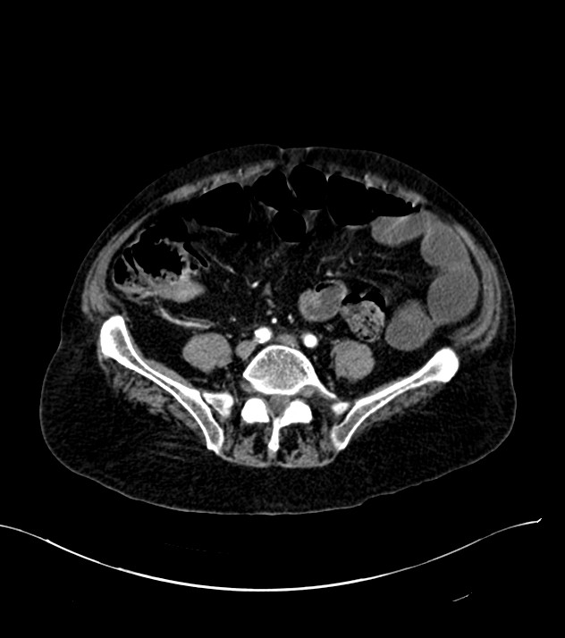 Cholangiocarcinoma with cerebral metastases (Radiopaedia 83519-98629 B 82).jpg