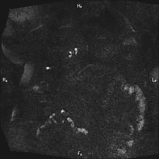 Choledochal cyst - type Ia (Radiopaedia 85673-101454 F 20).jpg
