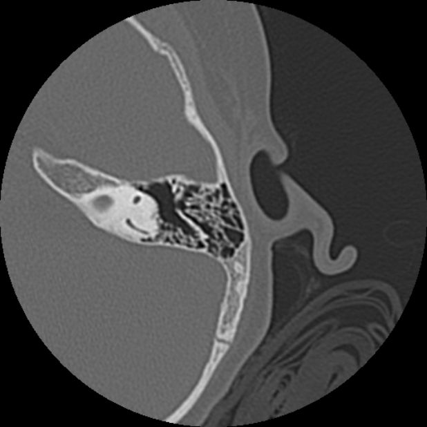 Cholesteatoma (Radiopaedia 73023-83750 Axial Left ear 55).jpg