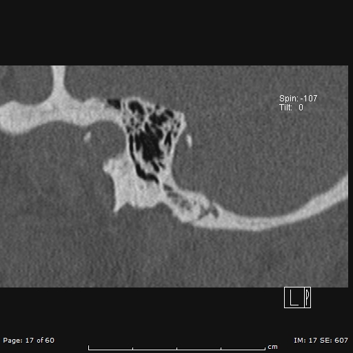 File:Cholesteatoma - external auditory canal (Radiopaedia 88452-105096 Sagittal bone window 17).jpg