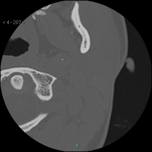 File:Cholesterol granuloma of the petrous apex (Radiopaedia 64358-73141 Axial bone window 100).jpg