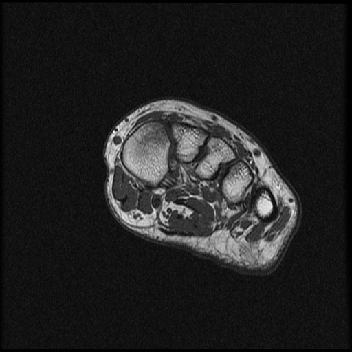 File:Chondroblastoma - midfoot (Radiopaedia 64831-73765 Short axis T1 19).jpg