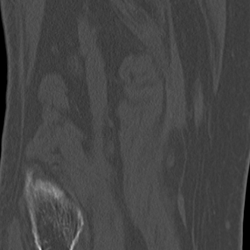 Chondrocalcinosis (Radiopaedia 16275-15955 Coronal bone window 50).jpg