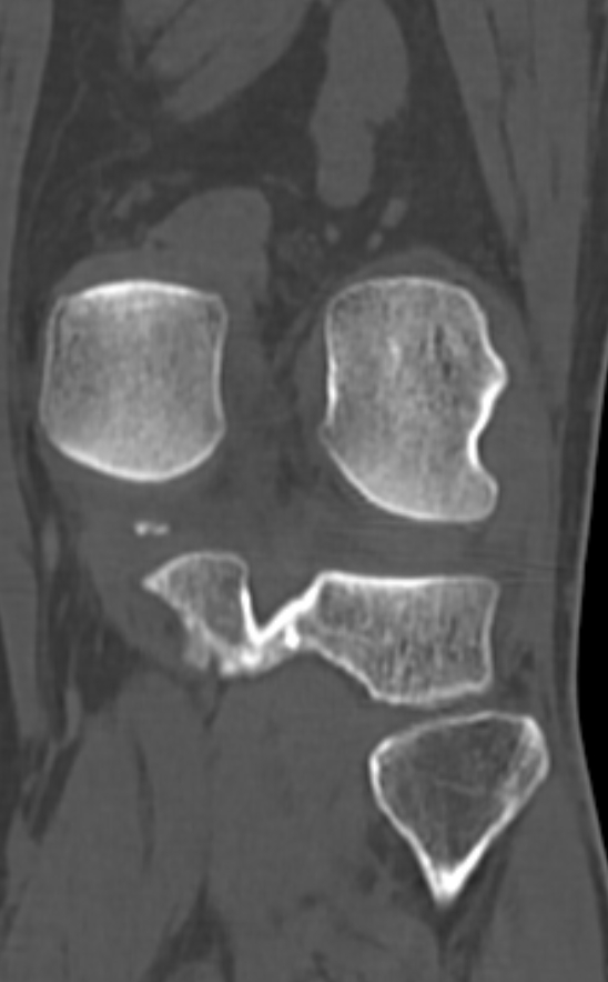 Chondrocalcinosis (Radiopaedia 82862-97173 Coronal bone window 59).jpg