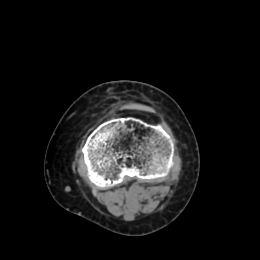 Chondrosarcoma - femur (Radiopaedia 64187-72954 Axial non-contrast 63).jpg