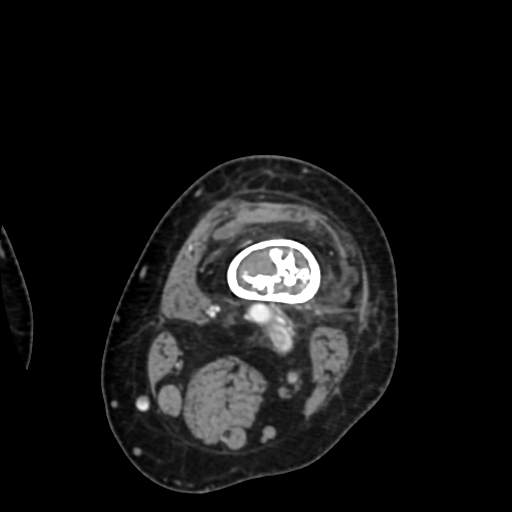 Chondrosarcoma - femur (Radiopaedia 64187-72954 Axial with contrast 20).jpg