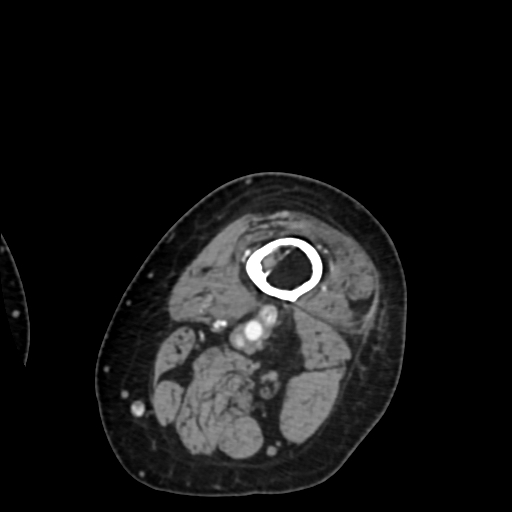 Chondrosarcoma - femur (Radiopaedia 64187-72954 Axial with contrast 5).jpg