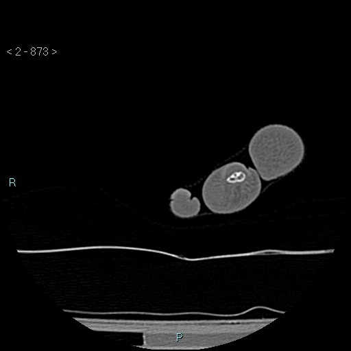 Chondrosarcoma - phalanx (Radiopaedia 69047-78812 Axial bone window 127).jpg