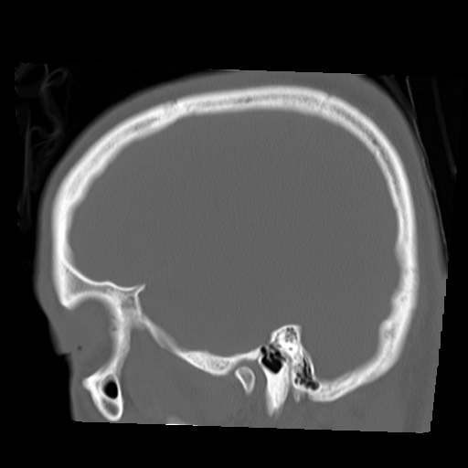 File:Chondrosarcoma - sphenoid wing (Radiopaedia 58259-67828 Sagittal bone window 7).jpg