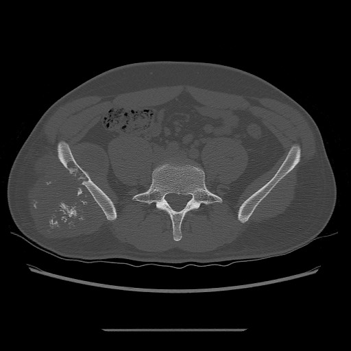 File:Chondrosarcoma of iliac wing (Radiopaedia 63861-72599 Axial bone window 39).jpg