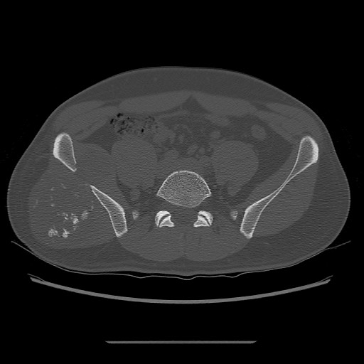 File:Chondrosarcoma of iliac wing (Radiopaedia 63861-72599 Axial bone window 44).jpg