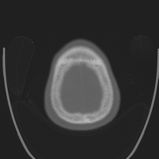 Chondrosarcoma of skull base- grade II (Radiopaedia 40948-43653 Axial bone window 46).png