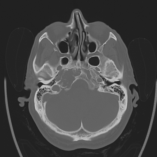 Chondrosarcoma of skull base- grade II (Radiopaedia 40948-43653 Axial bone window 8).png