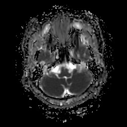 File:Chordoid glioma of third ventricle (Radiopaedia 91612-109340 Axial ADC 7).jpg