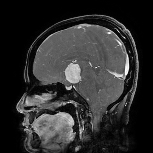 Chordoid glioma of third ventricle (Radiopaedia 91612-109340 F 103).jpg