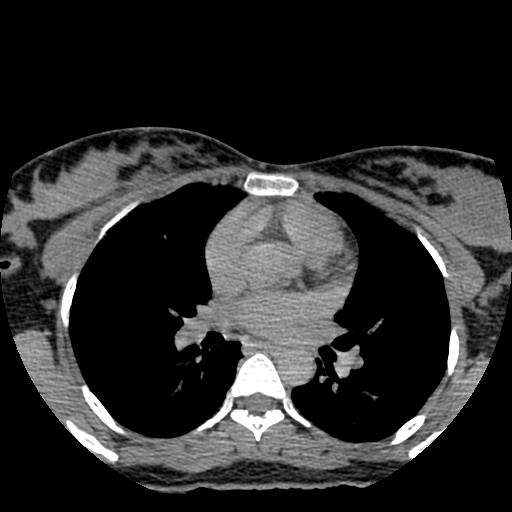 File:Choriocarcinoma of ovary with cerebral and pulmonary metastases (Radiopaedia 25983-26119 Axial non-contrast 137).jpg