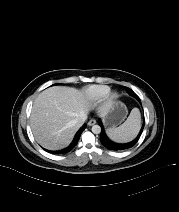 Chromophobe renal cell carcinoma (Radiopaedia 84255-99542 F 9).jpg