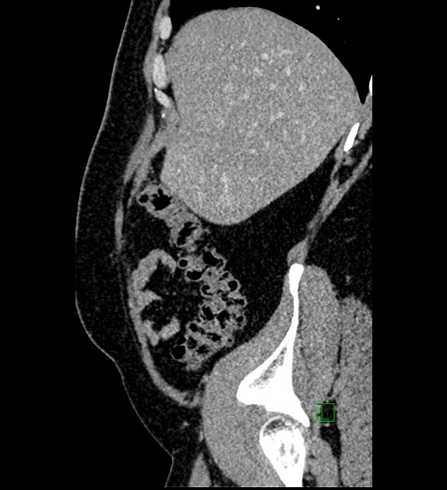 Chromophobe renal cell carcinoma (Radiopaedia 84286-99573 I 154).jpg