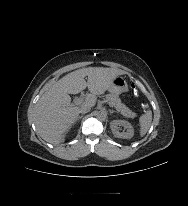 Chromophobe renal cell carcinoma (Radiopaedia 84337-99644 Axial non-contrast 27).jpg