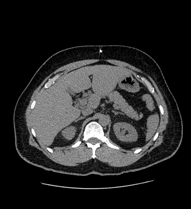 Chromophobe renal cell carcinoma (Radiopaedia 84337-99693 Axial non-contrast 36).jpg
