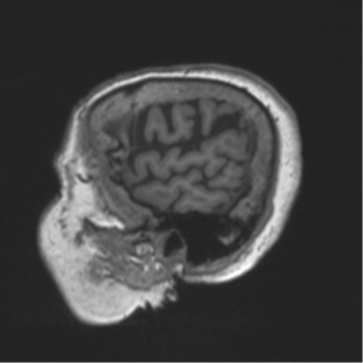 Chronic hypertensive encephalopathy (Radiopaedia 39993-42482 Sagittal T1 17).png