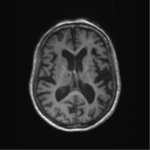 Chronic hypertensive encephalopathy (Radiopaedia 72844-83495 Axial T1 34).png