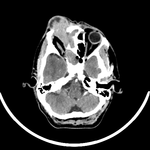 Chronic invasive fungal sinusitis with intraorbital and intracranial extension (Radiopaedia 56387-63046 B 103).jpg