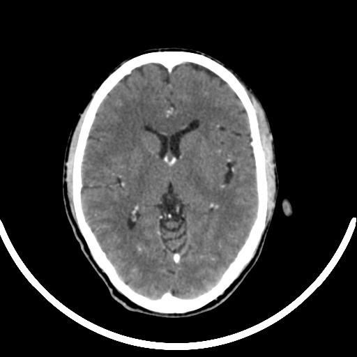 Chronic invasive fungal sinusitis with intraorbital and intracranial extension (Radiopaedia 56387-63046 B 179).jpg