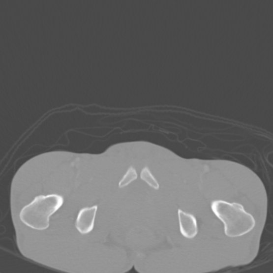 Chronic large bowel pseudo-obstruction (Radiopaedia 43181-46492 Axial bone window 164).jpg