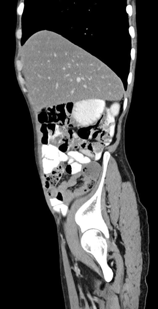 Chronic small bowel volvulus (Radiopaedia 75224-86322 C 116).jpg