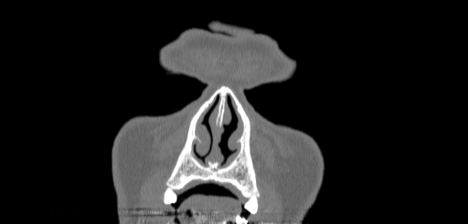 Chronic sphenoidal sinusitis (Radiopaedia 62030-70122 Coronal bone window 1).jpg