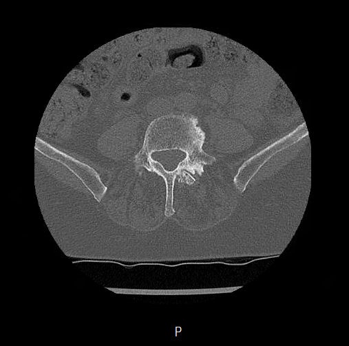 Chronic spinal hematoma with cauda equina syndrome (Radiopaedia 75745-88197 Axial bone window 57).png