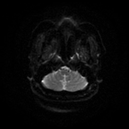 Chronic submandibular sialadenitis (Radiopaedia 61852-69885 Axial DWI 36).jpg