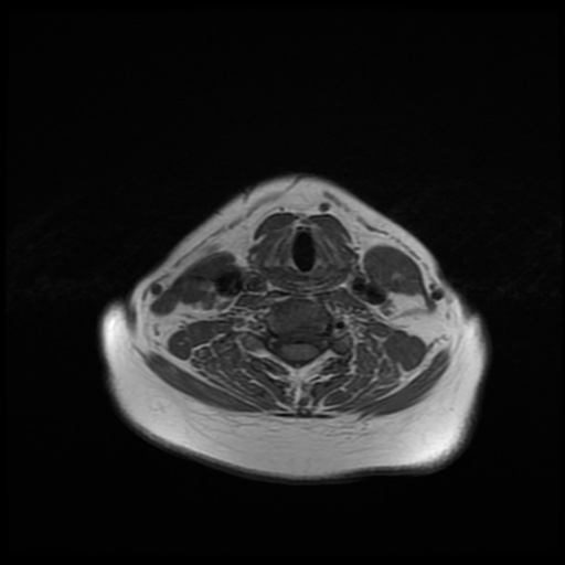 File:Chronic submandibular sialadenitis (Radiopaedia 61852-69885 Axial T1 21).jpg