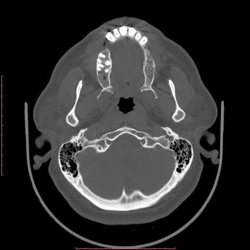 Chronic submandibular sialolithiasis (Radiopaedia 69817-79814 Axial bone window 1).jpg
