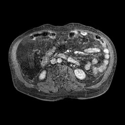 Cirrhosis and hepatocellular carcinoma in the setting of hemochromatosis (Radiopaedia 75394-86594 Axial T1 C+ fat sat 266).jpg