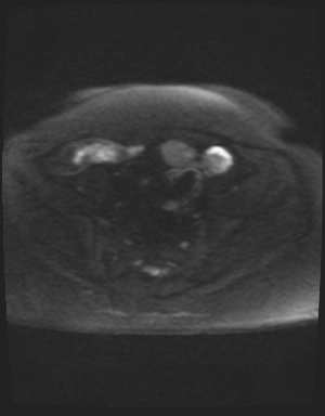 Class II Mullerian duct anomaly- unicornuate uterus with rudimentary horn and non-communicating cavity (Radiopaedia 39441-41755 Axial DWI 39).jpg