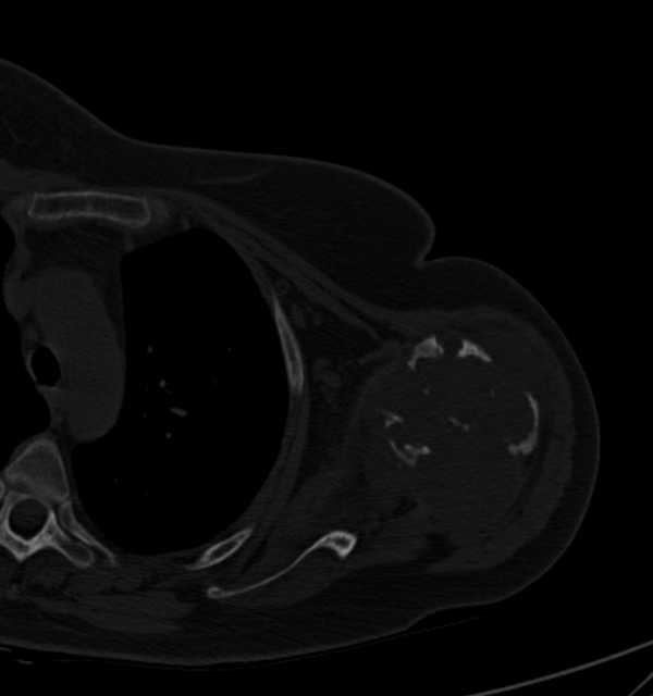 Clear cell chondrosarcoma - humerus (Radiopaedia 63104-71612 Axial bone window 53).jpg