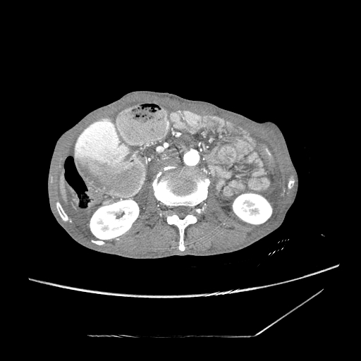 Closed-loop obstruction due to peritoneal seeding mimicking internal hernia after total gastrectomy (Radiopaedia 81897-95864 A 79).jpg