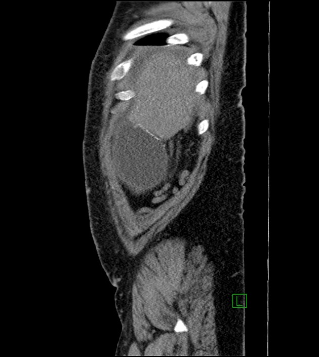Closed-loop small bowel obstruction-internal hernia (Radiopaedia 78439-91096 C 127).jpg
